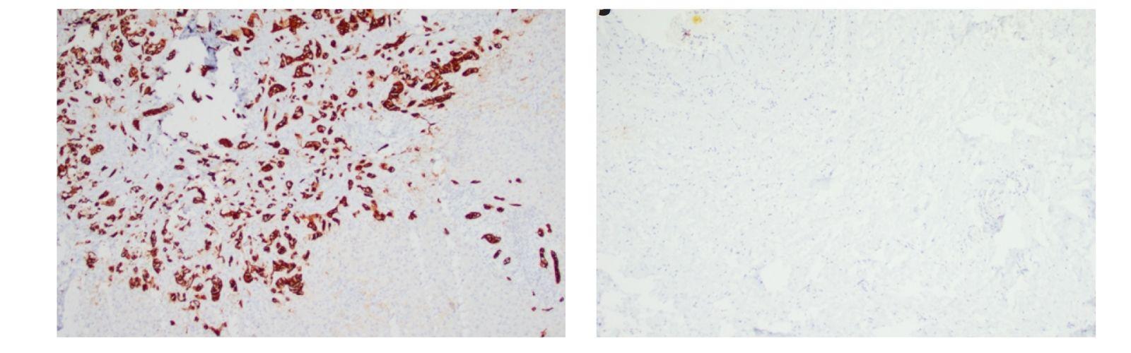 Research image of an exceptional responder to the clinical trial with metastatic pancreatic adenocarcinoma at diagnosis