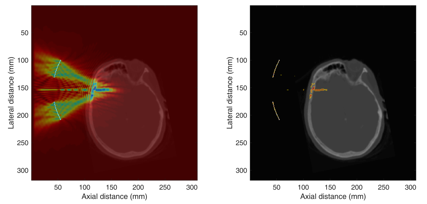 MR images of brain using focused ultrasound Two research pictures of MR scans of brain illustrating focused ultrasound application
