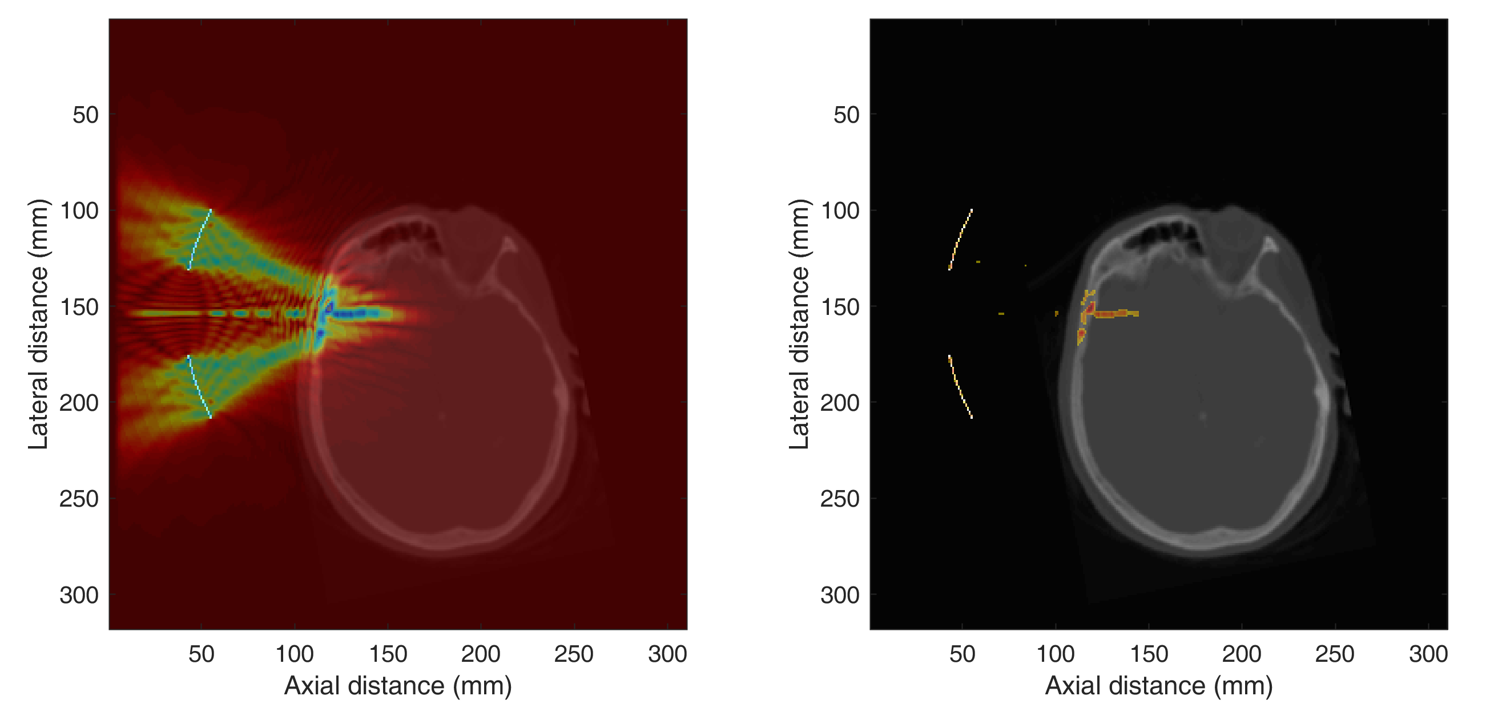 Two research pictures of MR scans of brain illustrating focused ultrasound application