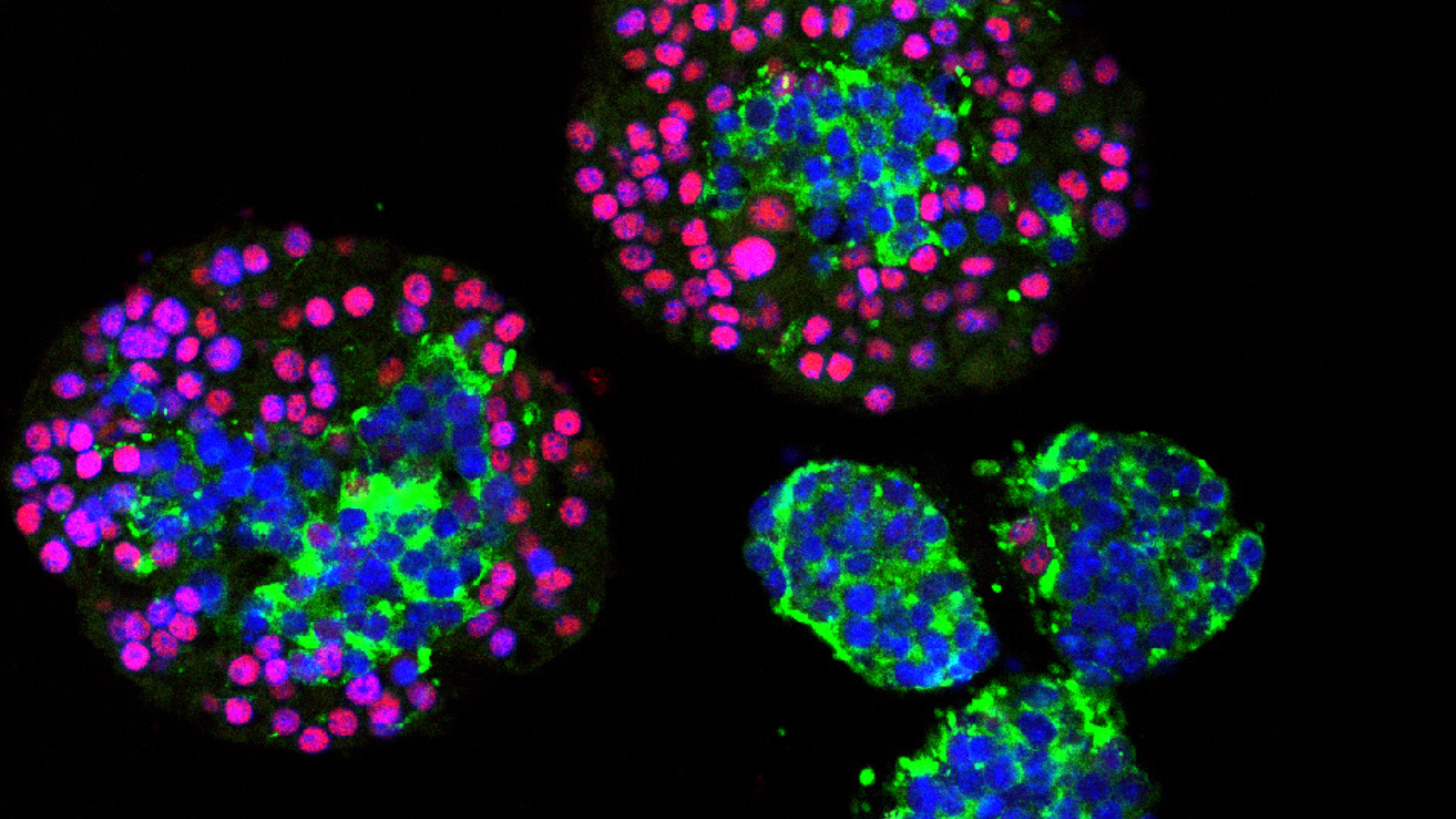 In this study, mouse prostate tumor organoids show a mix of neuroendocrine (green) and adenocarcinoma (red/pink) cells, revealing how prostate cancer can shift between these identities to evade treatment. 