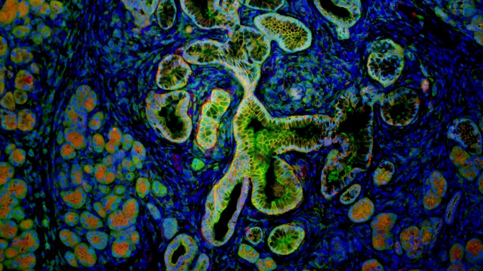 Immunofluorescent staining of a pancreatic ductal adenocarcinoma tumor for the tumor lineage label YFP (green), the epithelial protein ECADHERIN (red), and DAPI (blue).