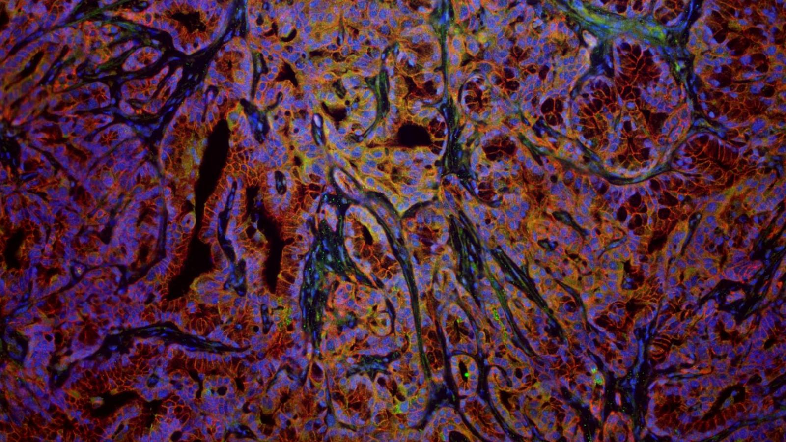 Immunofluorescent staining of a pancreatic ductal adenocarcinoma tumor for the tumor lineage label YFP (green), the epithelial protein ECADHERIN (red), and DAPI (blue).