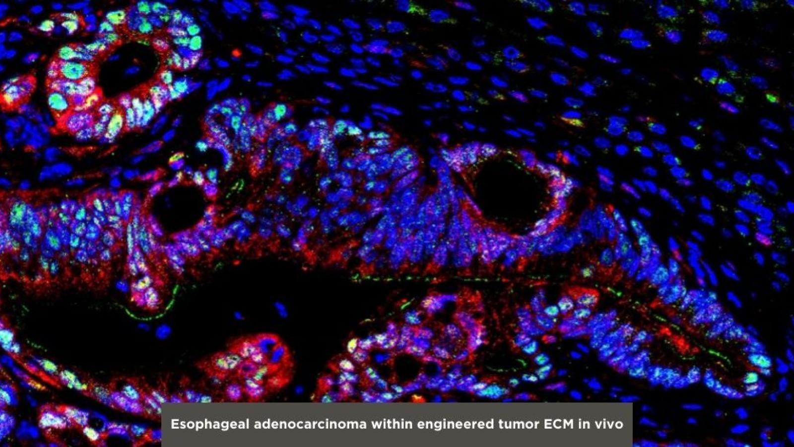 Esophageal adenocarcinoma within engineered tumor ECM in vivo