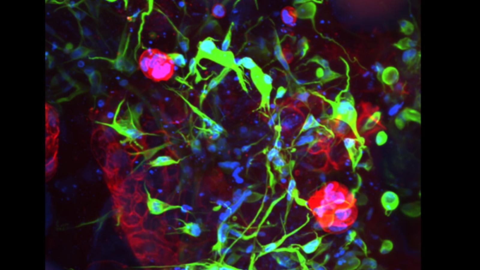 Assembloid co-culture model composed of patient derived organoids