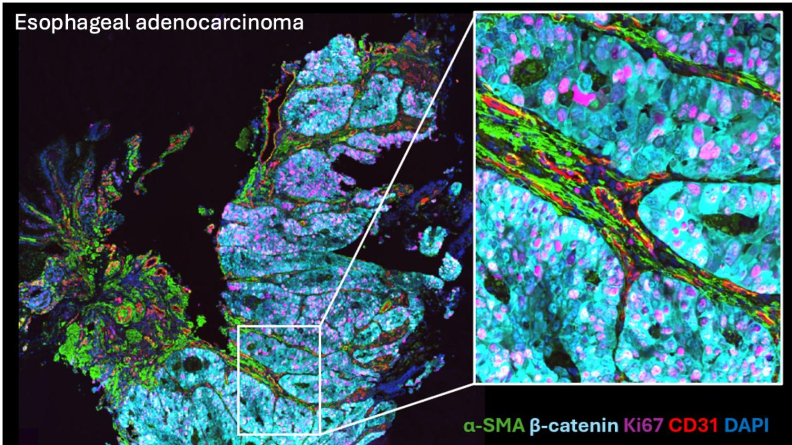 Multiplex immunofluorescence of an esophageal adenocarcinoma tumor illustrating proliferating tumor cells (Ki-67, β-catenin) and adjacent stroma (α-SMA) and blood vessels (CD31)