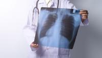 Doctor examines lung x-ray