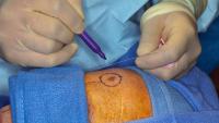 A surgeon circling a mole on a patient that he is about to operate on.