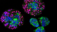 In this study, mouse prostate tumor organoids show a mix of neuroendocrine (green) and adenocarcinoma (red/pink) cells, revealing how prostate cancer can shift between these identities to evade treatment.