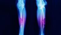 Leg X-ray showing sarcoma