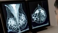 breast MRI