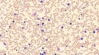 Blood smear showing certain cells stained blue, indicating abnormality