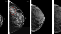 A breast MRI showing dense breasts
