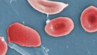 Research image showing sickle cells amongst normal red blood cells.