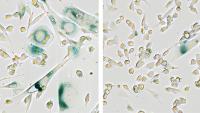 Targeting SMARCAL1 induces growth arrest and senescence in ALT+ cancer cells (blue stained cells)