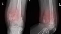 X ray showing sarcoma