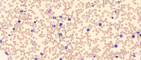 Blood smear showing certain cells stained blue, indicating abnormality