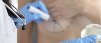 A doctor making markings on a patient's breast before a mastectomy.