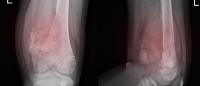 X ray showing sarcoma